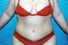 ofodile plastic surgery, fat suction
